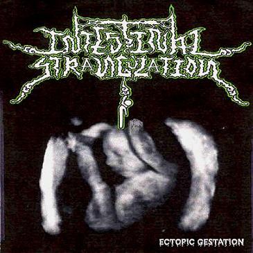 INTESTINAL STRANGULATION - Ectopic Gestation cover 