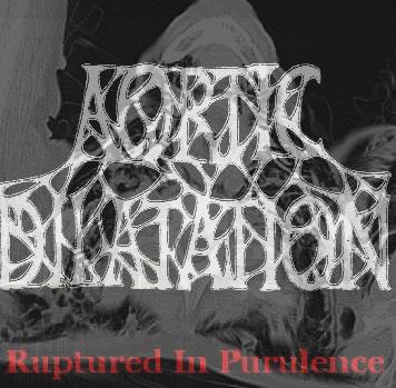 AORTIC DILATATION - Ruptured in Purulence cover 