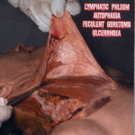 LYMPHATIC PHLEGM - Lymphatic Phlegm / Autophagia / Feculent Goretomb / Ulcer cover 